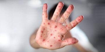 Saúde alerta para cuidados redobrados com o sarampo